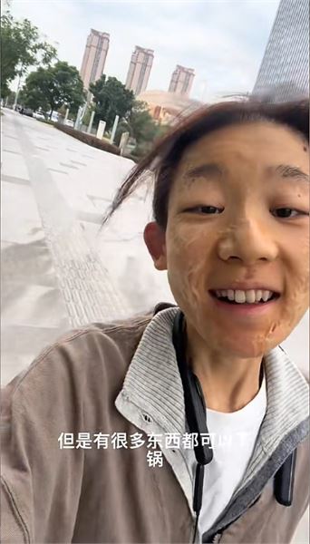 因火災留下傷疤，陳加瓦回應大家最關心的幾個問題